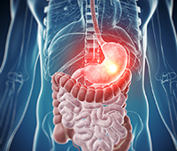 PEPTIC ULCER-STOMACH ULCER CAUSES